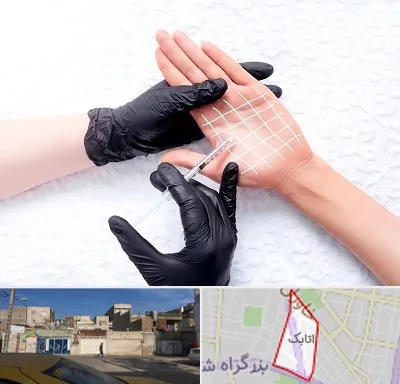 تزریق بوتاکس کف دست در اتابک