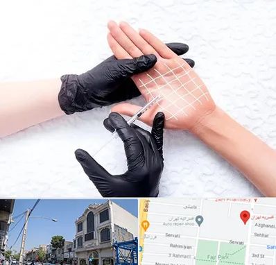 تزریق بوتاکس کف دست در افسریه 