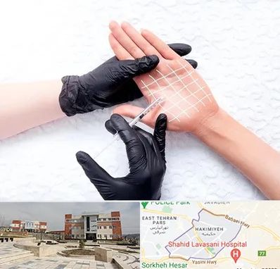 تزریق بوتاکس کف دست در حکیمیه 