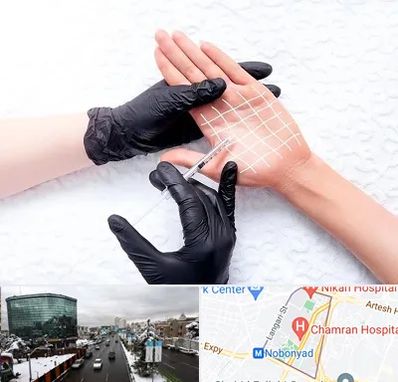 تزریق بوتاکس کف دست در اقدسیه 