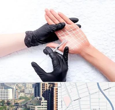 تزریق بوتاکس کف دست در خیابان بهشتی