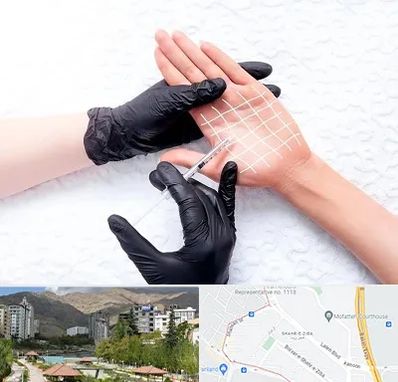 تزریق بوتاکس کف دست در شهر زیبا 