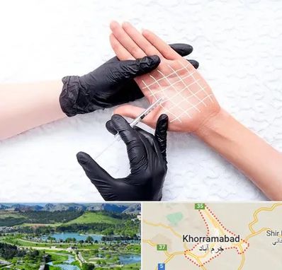 تزریق بوتاکس کف دست در خرم آباد