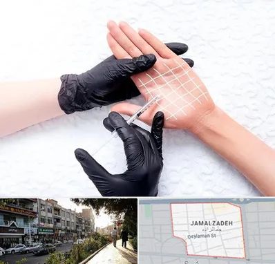 تزریق بوتاکس کف دست در خیابان جمالزاده