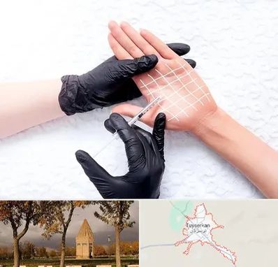 تزریق بوتاکس کف دست در تویسرکان