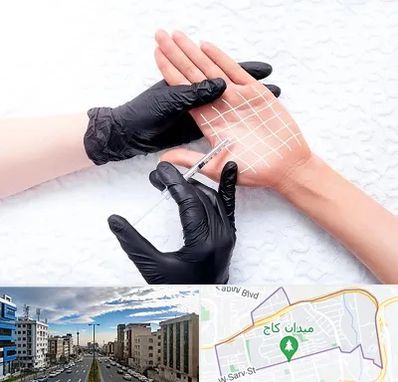 تزریق بوتاکس کف دست در سعادت آباد 