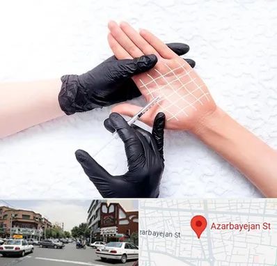 تزریق بوتاکس کف دست در خیابان آذربایجان