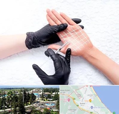 تزریق بوتاکس کف دست در رودسر