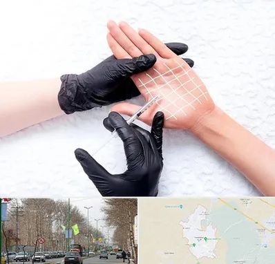 تزریق بوتاکس کف دست در نظرآباد کرج