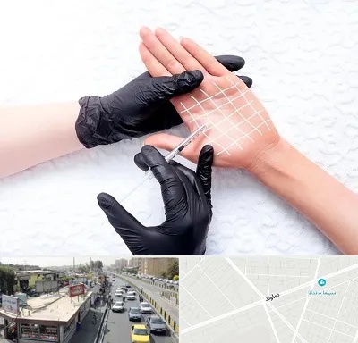 تزریق بوتاکس کف دست در خیابان دماوند