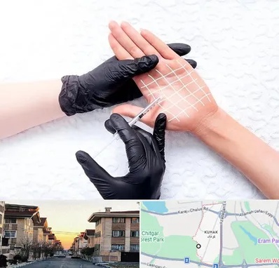 تزریق بوتاکس کف دست در کوهک