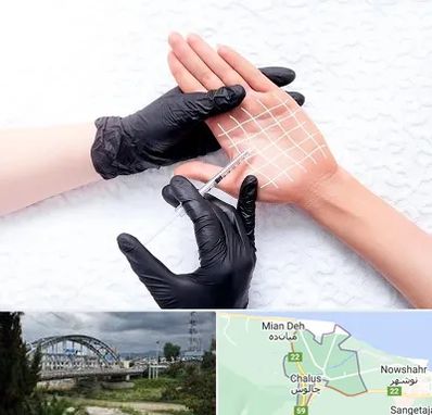 تزریق بوتاکس کف دست در چالوس