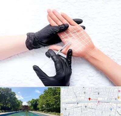 تزریق بوتاکس کف دست در هشت بهشت اصفهان