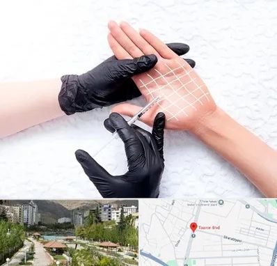 تزریق بوتاکس کف دست در بلوار تعاون