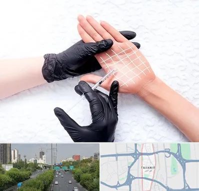 تزریق بوتاکس کف دست در توانیر