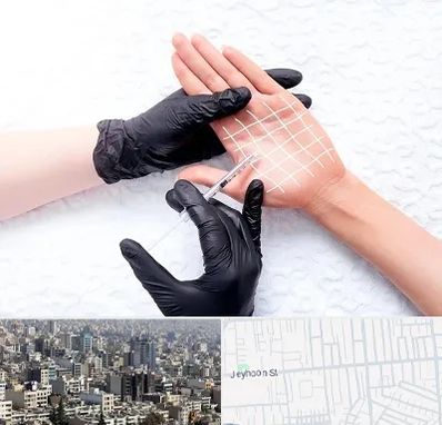 تزریق بوتاکس کف دست در جیحون