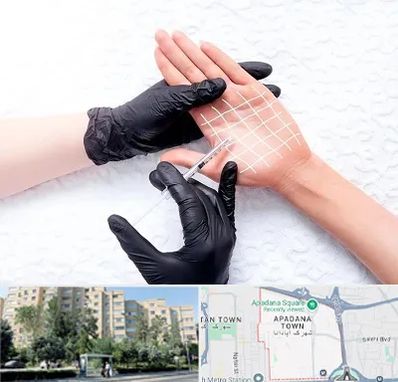 تزریق بوتاکس کف دست در آپادانا