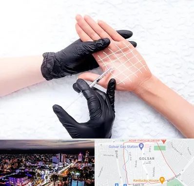 تزریق بوتاکس کف دست در گلسار رشت 