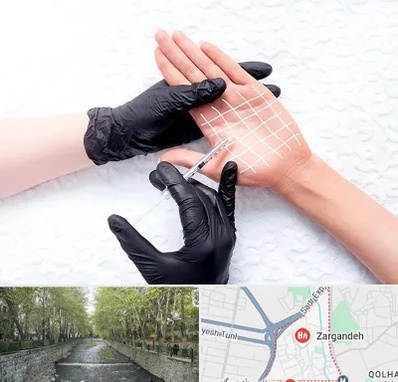 تزریق بوتاکس کف دست در زرگنده