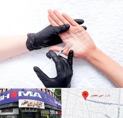 تزریق بوتاکس کف دست در امین حضور