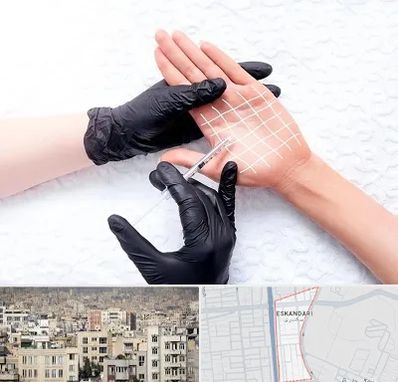 تزریق بوتاکس کف دست در اسکندری