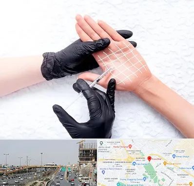 تزریق بوتاکس کف دست در بلوار توس مشهد