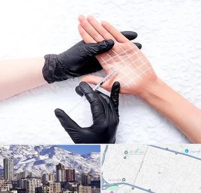 تزریق بوتاکس کف دست در ازگل