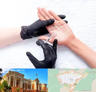 تزریق بوتاکس کف دست در خوی