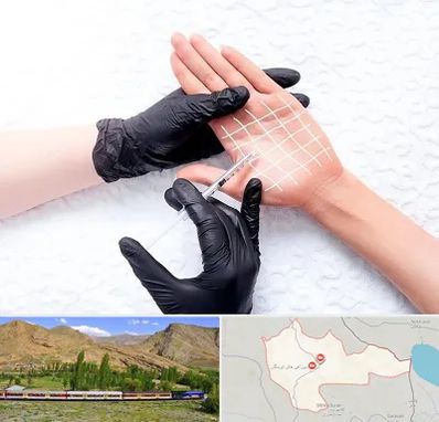 تزریق بوتاکس کف دست در خاش