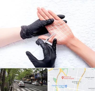 تزریق بوتاکس کف دست در ظفر 