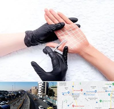 تزریق بوتاکس کف دست در پیروزی 