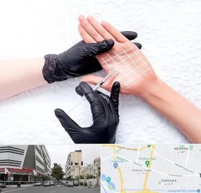 تزریق بوتاکس کف دست در بلوار فردوس 