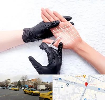 تزریق بوتاکس کف دست در شهناز تبریز