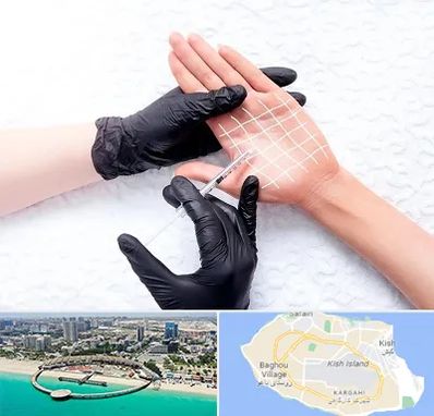 تزریق بوتاکس کف دست در کیش