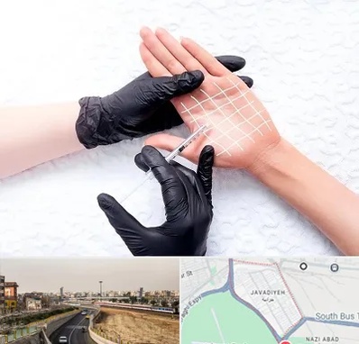 تزریق بوتاکس کف دست در جوادیه