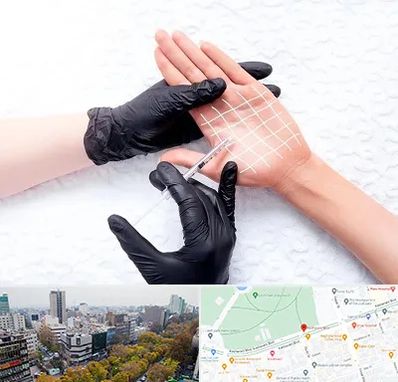 تزریق بوتاکس کف دست در بلوار کشاورز 