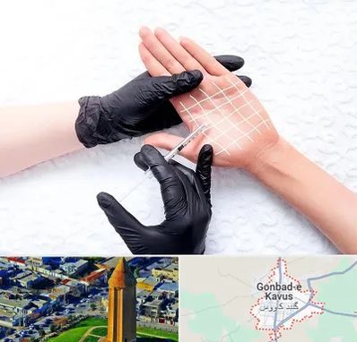 تزریق بوتاکس کف دست در گنبد کاووس