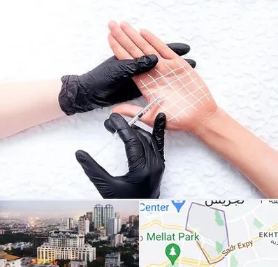 تزریق بوتاکس کف دست در الهیه 