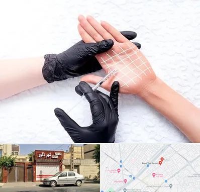 تزریق بوتاکس کف دست در باجک قم