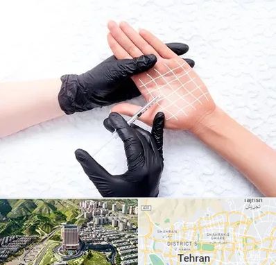 تزریق بوتاکس کف دست در شمال تهران 
