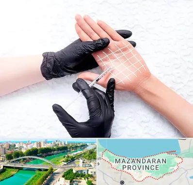 تزریق بوتاکس کف دست در مازندران
