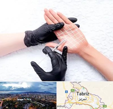 تزریق بوتاکس کف دست در تبریز