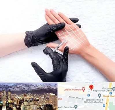 تزریق بوتاکس کف دست در جردن 