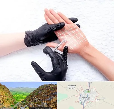 تزریق بوتاکس کف دست در کامیاران