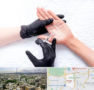 تزریق بوتاکس کف دست در گیشا 