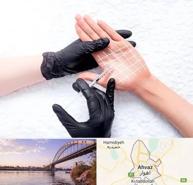 تزریق بوتاکس کف دست در اهواز