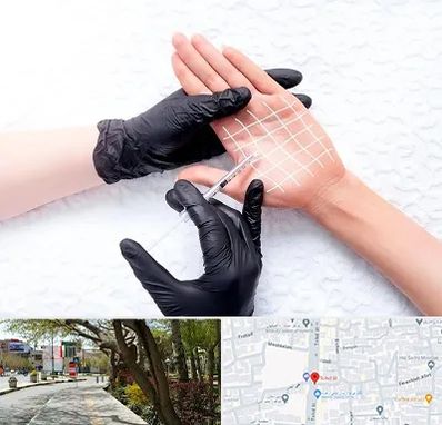 تزریق بوتاکس کف دست در خیابان توحید اصفهان