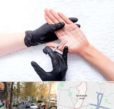 تزریق بوتاکس کف دست در کاشانک