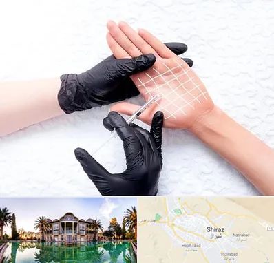 تزریق بوتاکس کف دست در شیراز