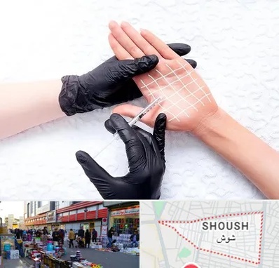 تزریق بوتاکس کف دست در شوش